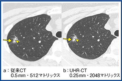 図4　最高分解能の画像の有用性（肺腺癌）