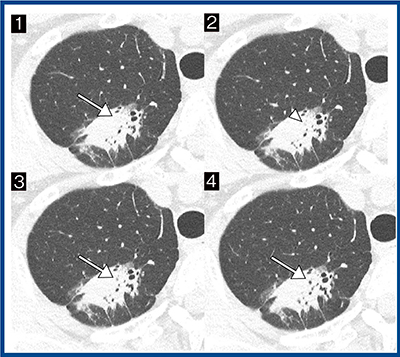 図5　最高分解能の画像による細気管支の途絶の評価（浸潤性肺腺癌） （1→4の順で頭側→尾側）