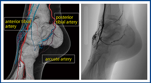 図4　症例4：足背動脈の高流速動静脈奇形における血管塞栓術前の評価
