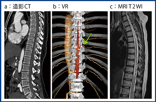 図5　症例5：脊髄硬膜動静脈瘻における血管塞栓術術前の評価