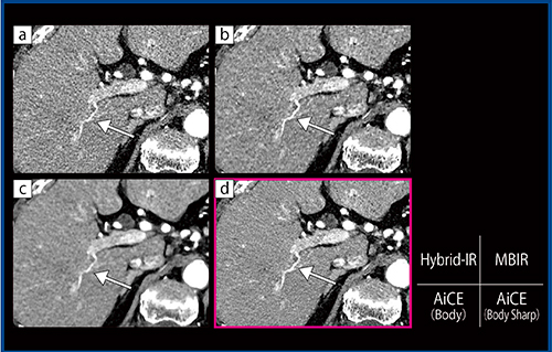 図4　HCC治療後症例（90歳代，女性）の動脈相における肝動脈末梢の描出