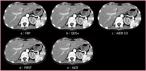 図2　1.5mGyで撮影した小児腹部CTのアキシャル画像（症例2）