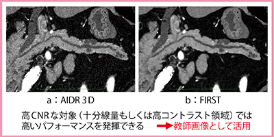 図3　16.3mGyで撮影した膵臓のCurved MPR画像