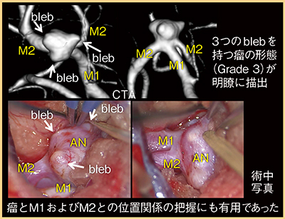 図1　症例1：CTAによる右MCA分岐部の動脈瘤の評価 （参考文献1）より引用転載）