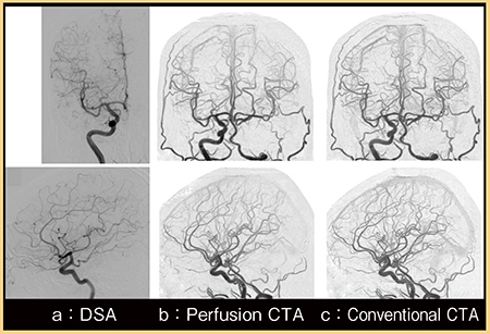 図2　症例2：Perfusion CTAとConventional CTAの画像比較 （参考文献2）より引用転載）