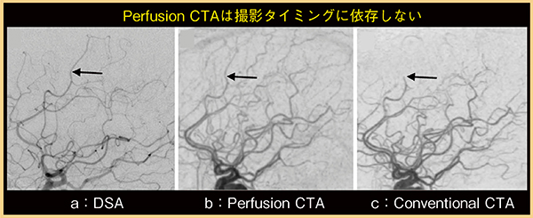 図3　症例3：Perfusion CTAとConventional CTAにおける末梢血管の描出能の比較 （参考文献2）より引用転載）