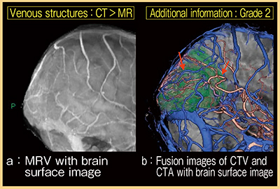 図4　症例4：MRV・脳表画像のフュージョン画像（a）およびCTV・CTA・脳表画像のフュージョン画像（b）の比較 （参考文献3）より引用転載）