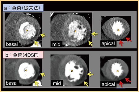 図2　4D Similarity Filterによるダイナミック画像の画質改善4） 70歳代，男性，左回旋枝の慢性完全閉塞（CTO）