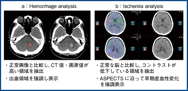 図1　Abierto RSS for Neuroの単純CT解析のアプリケーション