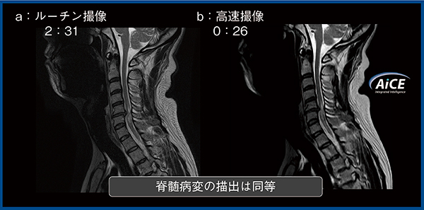 図2　頸椎のルーチン撮像と高速撮像の比較