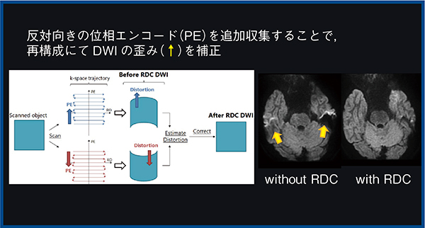 図5　歪み低減技術RDC DWIの概要