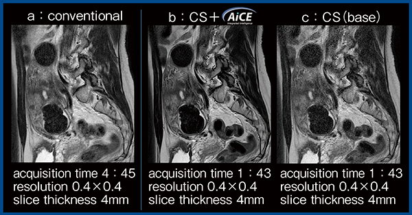 図2　AiCEを適用したCompressed SPEEDERと従来法の比較（子宮筋腫）