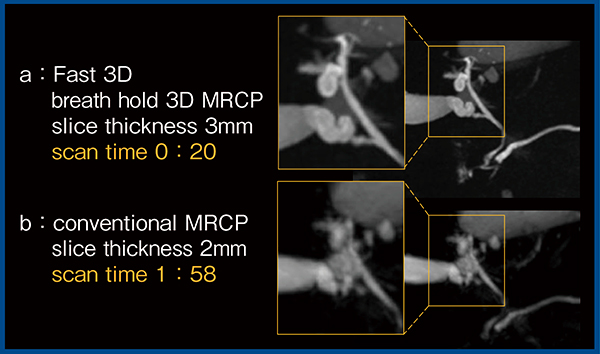 図3　MRCPにおけるFast 3Dモードと従来法の比較