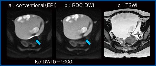 図6　RDC DWIと従来法の比較（卵巣成熟奇形腫）