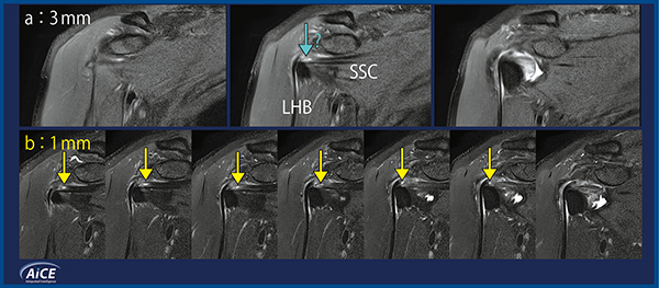 図1　右肩甲下筋腱断裂症例における2D 3mmと2D 1mmの画像比較 （画像ご提供：京都桂病院整形外科・新井隆三先生）
