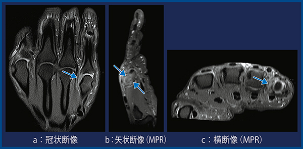 図5　症例3：右小指中手指節（MP）関節橈側側副靱帯断裂