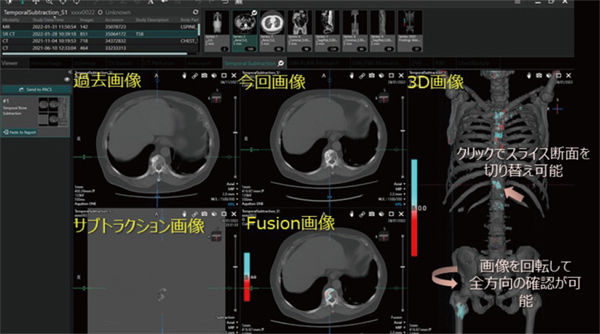 図4　Findings WorkflowでのTemporal Subtraction For Bone 解析結果表示例
