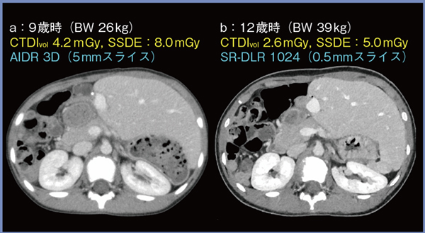 図5　症例3：先天性胆道閉鎖症にて生体肝移植後の女児