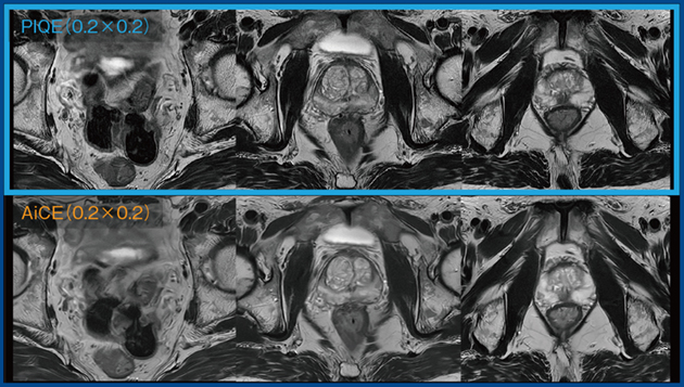 図6　AiCEとPIQEを用いた前立腺T2WI