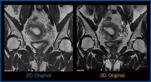 図7　女性骨盤の撮像における2D法（PIQE適用）と3D法の比較