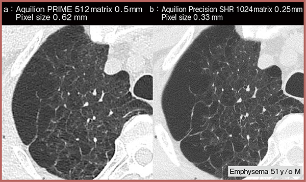 図2　従来CTと高精細CTの比較