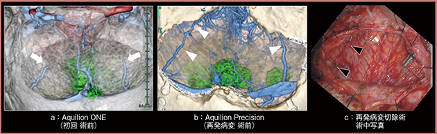 図2　髄膜腫症例に対する術前シミュレーション画像