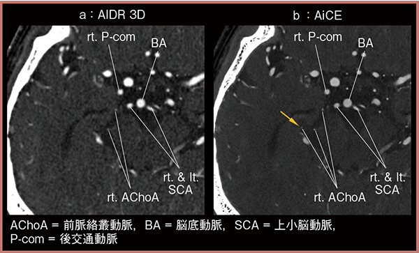 図3　AiCE Brain CTAにおける微細動脈の描出の評価