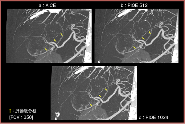 図1　実臨床画像におけるAiCEとPIQEの視認性の比較