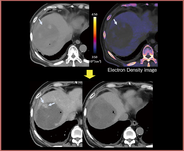 図4　電子密度画像によるDEB-TACE後の残存病変の予測