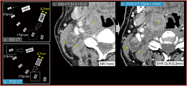 図1　EID-CT（512マトリクス，NRモード）とPCD-CT（1024マトリクス，SHRモード＋DLR）の比較