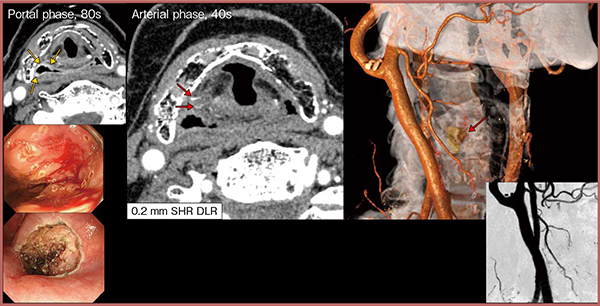 図2　PCD-CT（SHR＋DLR)による下咽頭早期がんの内視鏡手術前の血管評価