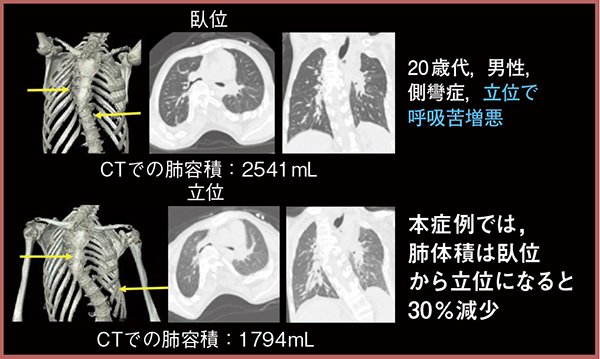 図3　臥位と立位における肺体積の変化