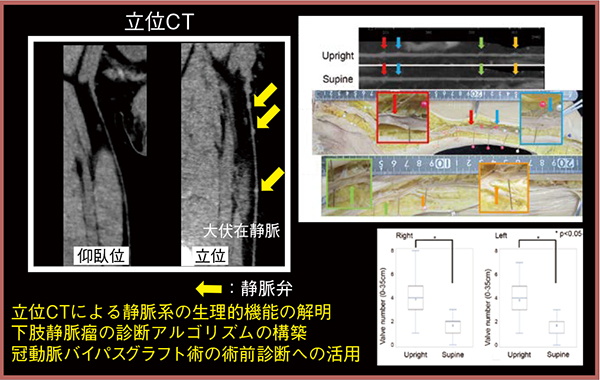 図5　立位撮影による下肢静脈の評価（図右側は参考文献4）より引用転載）