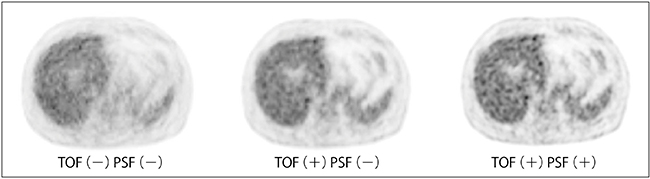 図5　各処理条件での画像の違い 「TOFなし・PSFなし」「TOFあり・PSFなし」「TOFあり・PSFあり」の臨床画像での違いを示す。TOFによりコントラストの改善が確認でき，PSFでさらに解像度が向上していることが確認できる。
