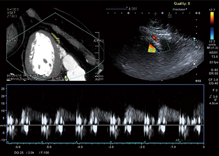 図1　冠動脈ドプラ検査をCT画像でガイドした例 （データご提供：岡山大学・高谷陽一先生）