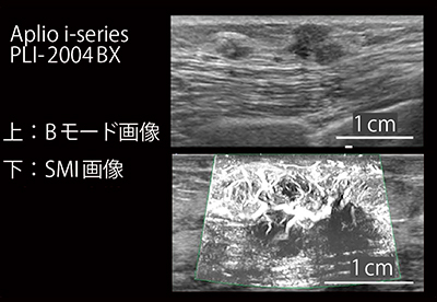 図1　PLI-2004BXの乳腺臨床画像 （画像ご提供：高松平和病院・何森亜由美先生）