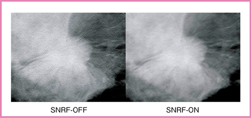 図2　臨床画像における投影像へのSNRF有無の差
