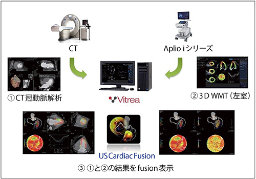 図4　US Cardiac Fusionの3D WMT解析結果表示例