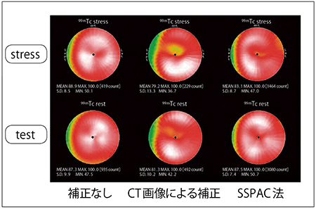 図7　SPECT/CT装置のCT画像を使った減弱補正とSSPAC法による減弱補正の比較 （画像ご提供：金沢大学様）