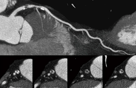 図3　Aquilion Precisionで撮影された冠動脈CT画像 （画像ご提供：藤田医科大学病院様）