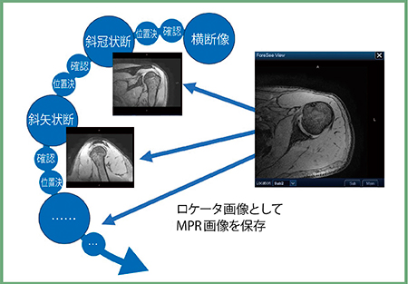 図2　MPR画像でのプランニング例