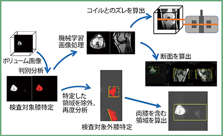 図3　SUREVOI Knee/KneeLine＋の検出プロセス概要