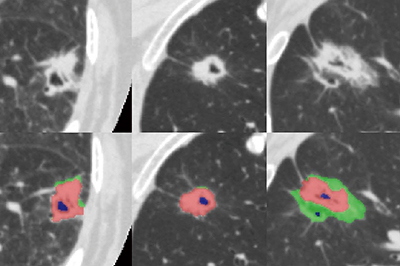 図1　肺野における領域抽出事例1） 上段は処理前の画像，下段はそれぞれのすりガラス成分（緑），充実成分（赤），キャビティ成分（青）をAIが区分した画像 （画像ご提供：藤田医科大学・大野良治教授）