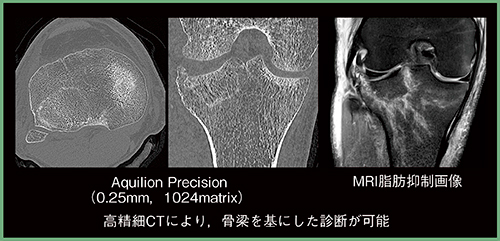 図1　高精細CTによる脛骨高原骨折の評価 （画像ご提供：大原綜合病院様）