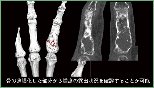 図2　高精細CTによる右手第2指腫瘍の評価 （画像ご提供：藤田医科大学病院様）