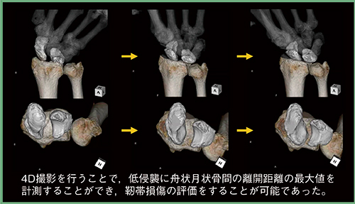 図3　舟状月状骨（SL）靭帯解離の4D評価 （画像ご提供：半田市立半田病院様）