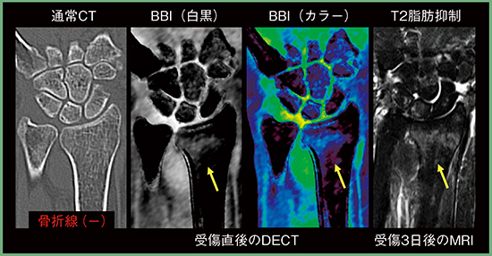 図5　橈骨遠位端骨折（X-P/MPR不顕性）のBBI評価 （画像ご提供：富山労災病院様）