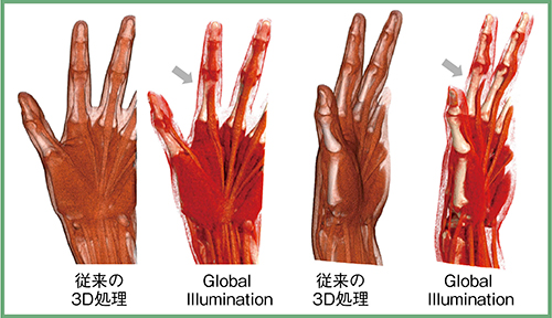 図6　Global Illuminationによる深指屈筋の腱断裂の描出 （画像ご提供：藤田医科大学病院様）