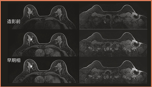 図3　ブレストSPEEDERの効果 右乳がん/左腋窩潰瘍。右コイルは乳房がコイル中心に，左コイルは腋窩付近にコイル位置をセッティング可能。 （画像ご提供：杏林大学医学部付属病院）