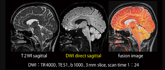 図2　Direct sagittal DWI